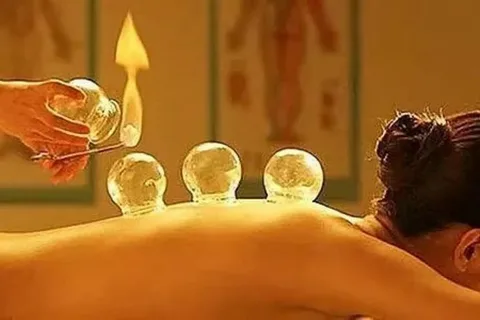 cupping treatment Melbourne