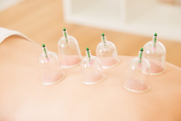 Advantages Of Using Cupping Therapy Melbourne
