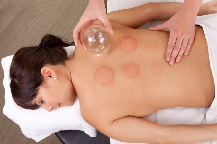 cupping therapy Melbourne