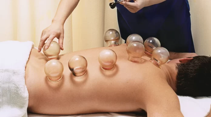 cupping therapy Melbourne