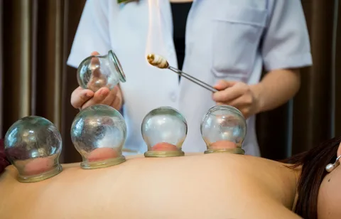 cupping therapy Melbourne